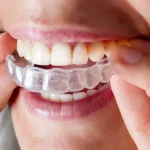 Navigating the Journey to Better Oral Health with Invisalign