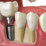 What Happens to Your Remaining Teeth When You Choose Dental Implants Over Bridges