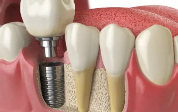What Happens to Your Remaining Teeth When You Choose Dental Implants Over Bridges