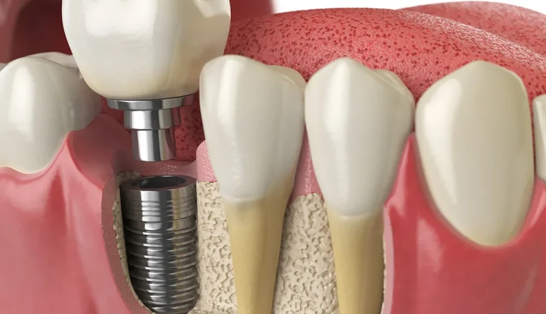 What Happens to Your Remaining Teeth When You Choose Dental Implants Over Bridges