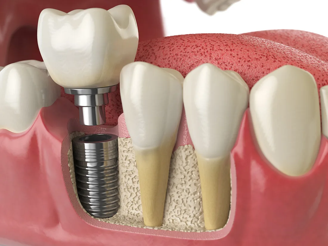 What Happens to Your Remaining Teeth When You Choose Dental Implants Over Bridges